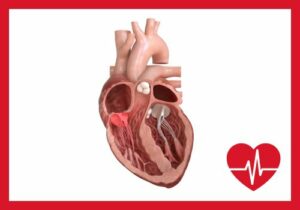Aortenklappeninsuffizienz: Ursachen, Symptome und Behandlungsmöglichkeiten