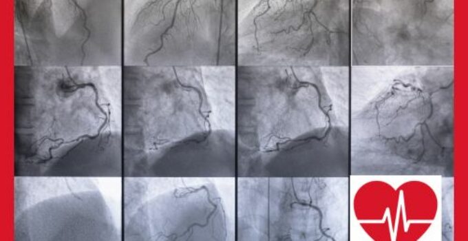 Herzkatheter und Koronarangiographie: Schlüsselverfahren der Kardiologie