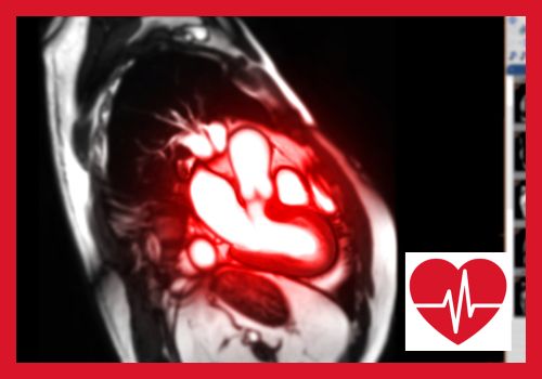 Kardio-MRT: Einsatz und Vorteile in der kardiovaskulären Diagnostik