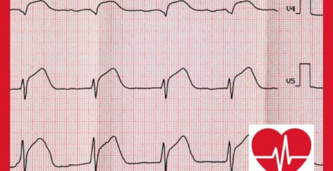 Myokardszintigraphie: Innovative Diagnostik der Herzdurchblutung