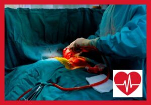 Herz-Bypass-OP: Ablauf & Risiken – Ein professioneller Leitfaden