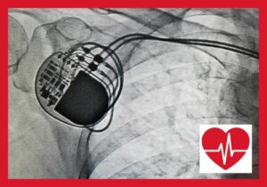 Herzschrittmacher: Innovative Technologien und neueste Entwicklungen