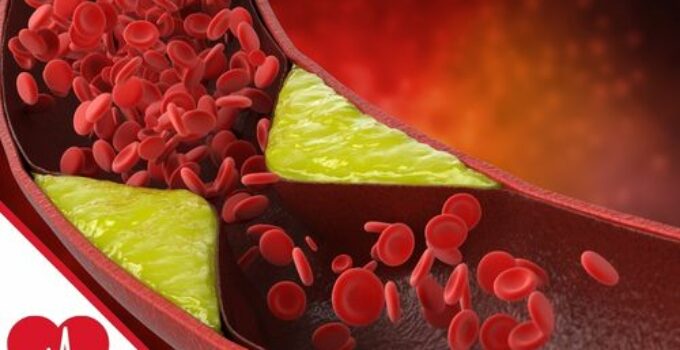 Arteriosklerose: Was ist Artierienverkalkung?